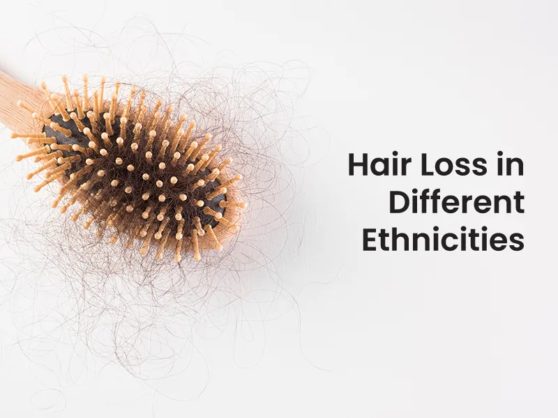 Hair Loss in Different Ethnicities